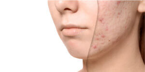 Close-up of acne blemishes on a cheek.