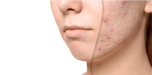 Close-up of acne blemishes on a cheek.