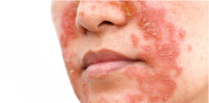 Close-up of red, scaly patches on a person’s face.