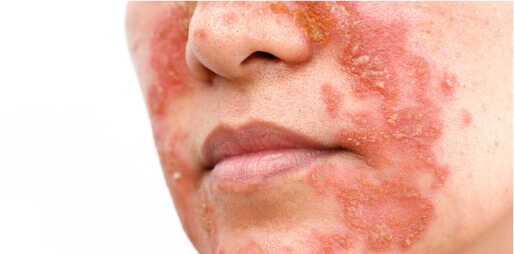 Close-up of red, scaly patches on a person’s face.