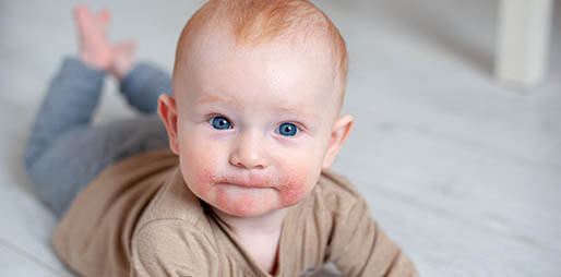 Close-up of a baby’s face with red, irritated skin.