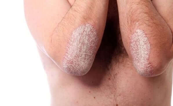 Scaly skin patches on both elbows.