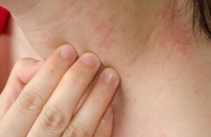 Person touching a red, irritated patch on the neck.