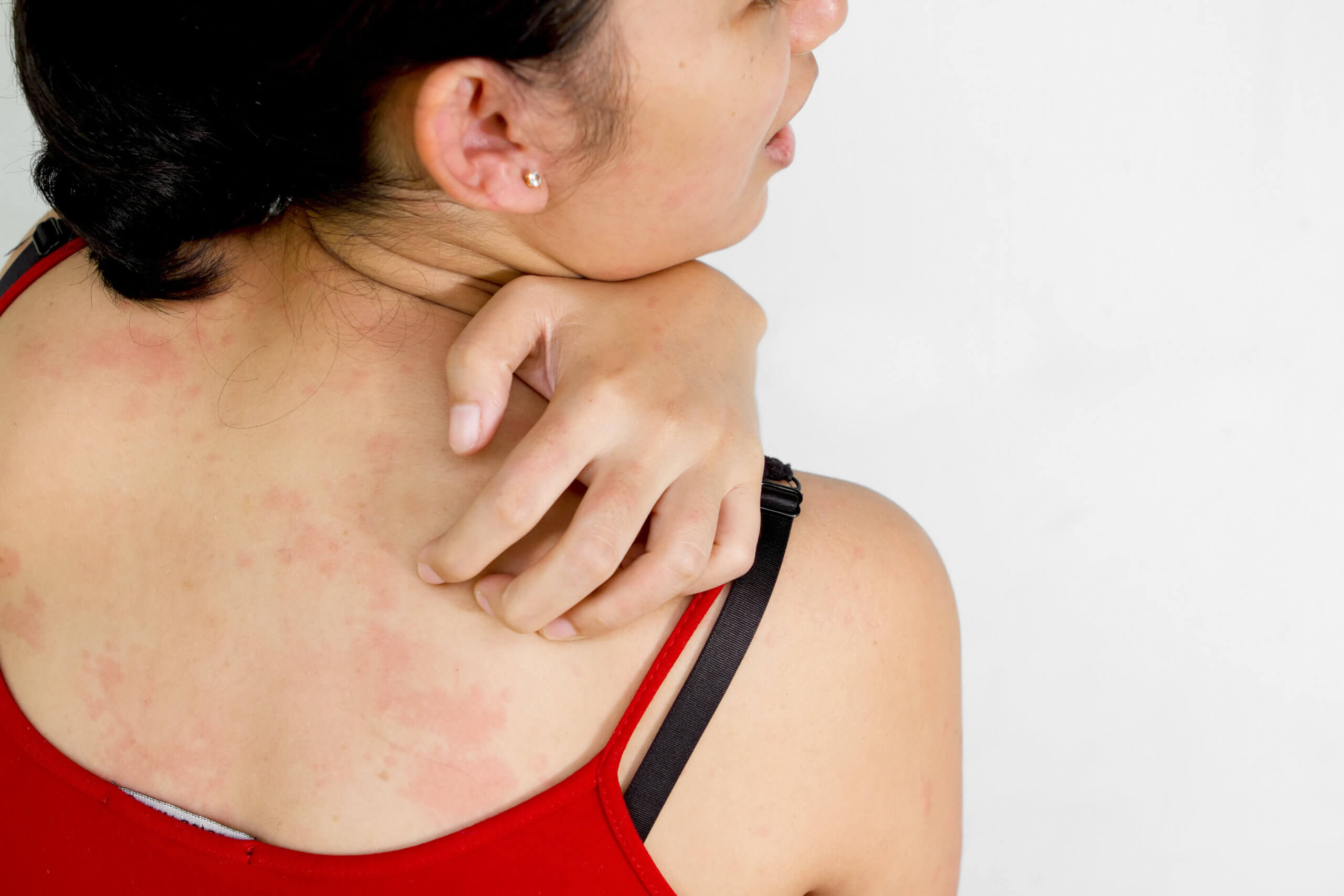 Woman scratching the skin on the back of her neck.