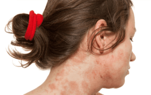 Red, irritated skin on the side and back of a woman’s neck.