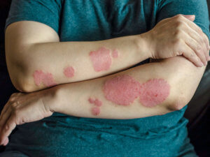 Red, scaly skin patches on a person’s forearms.