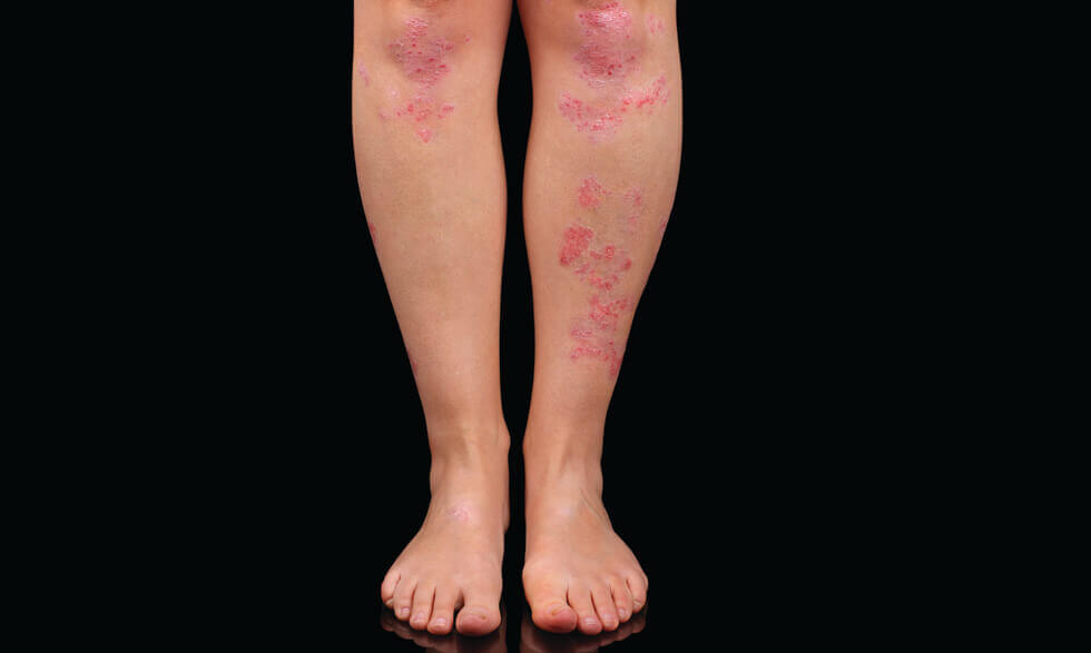 Red, scaly skin patches on the lower legs.