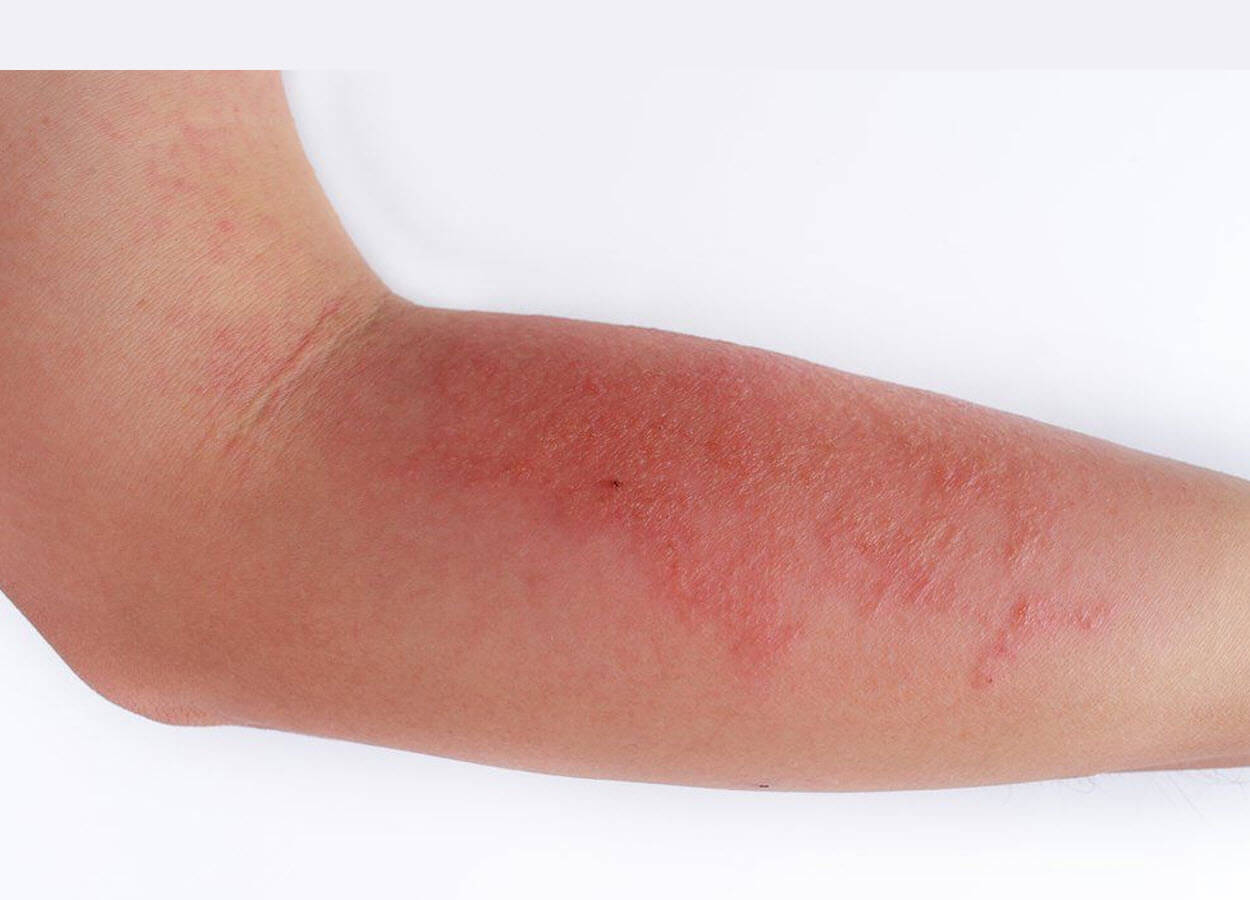 Red, irritated skin on the inside of an elbow.