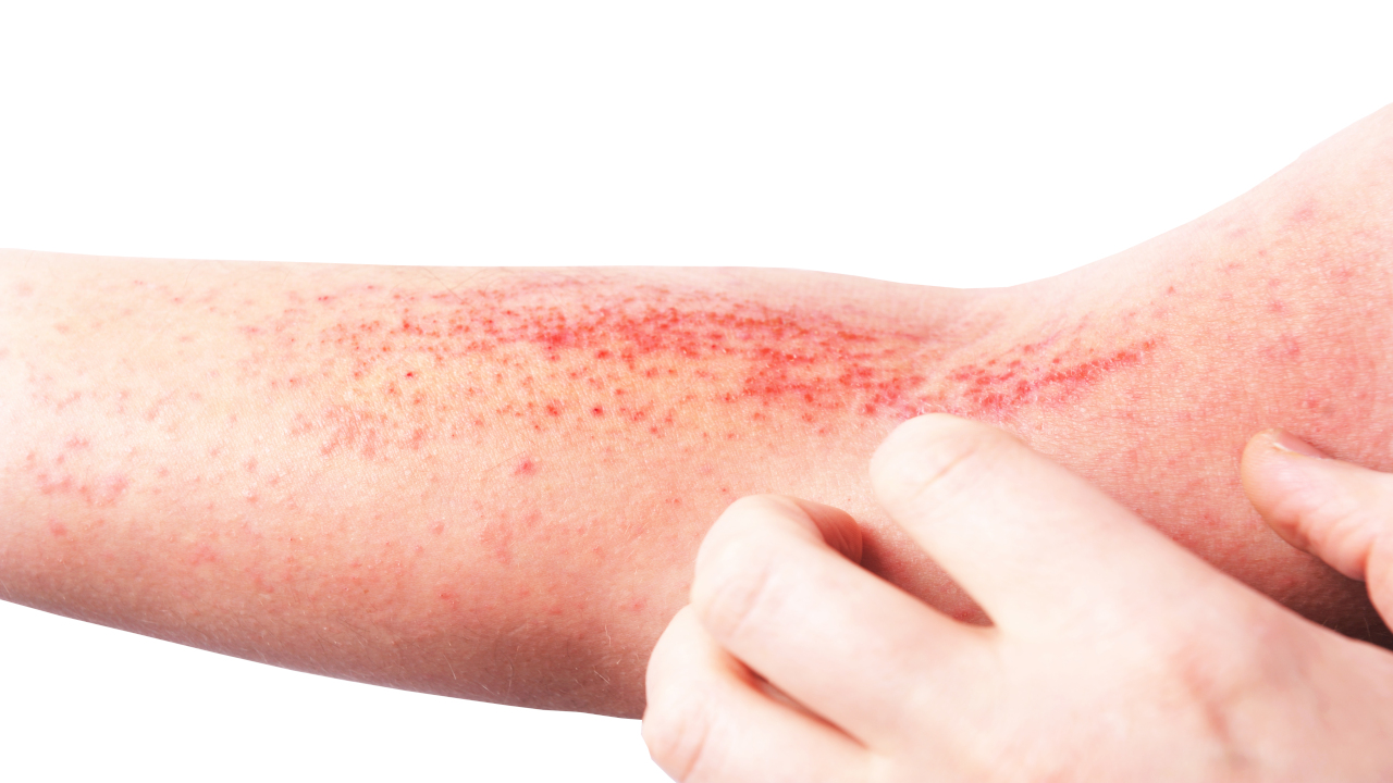 Close-up of red, irritated skin at the inner elbow.