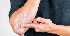 Person applying moisturizer to a dry, scaly patch on the elbow.