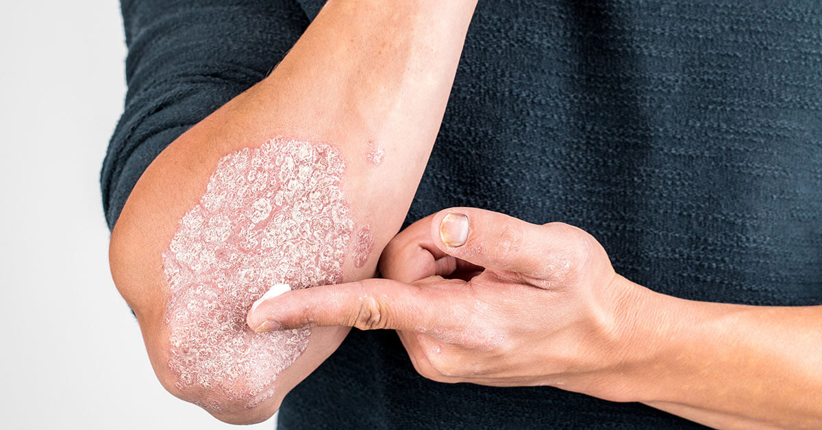 Person applying moisturizer to a dry, scaly patch on the elbow.