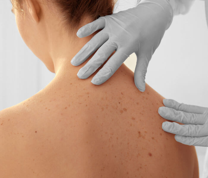 Gloved clinician examining the skin on a patient’s upper back.