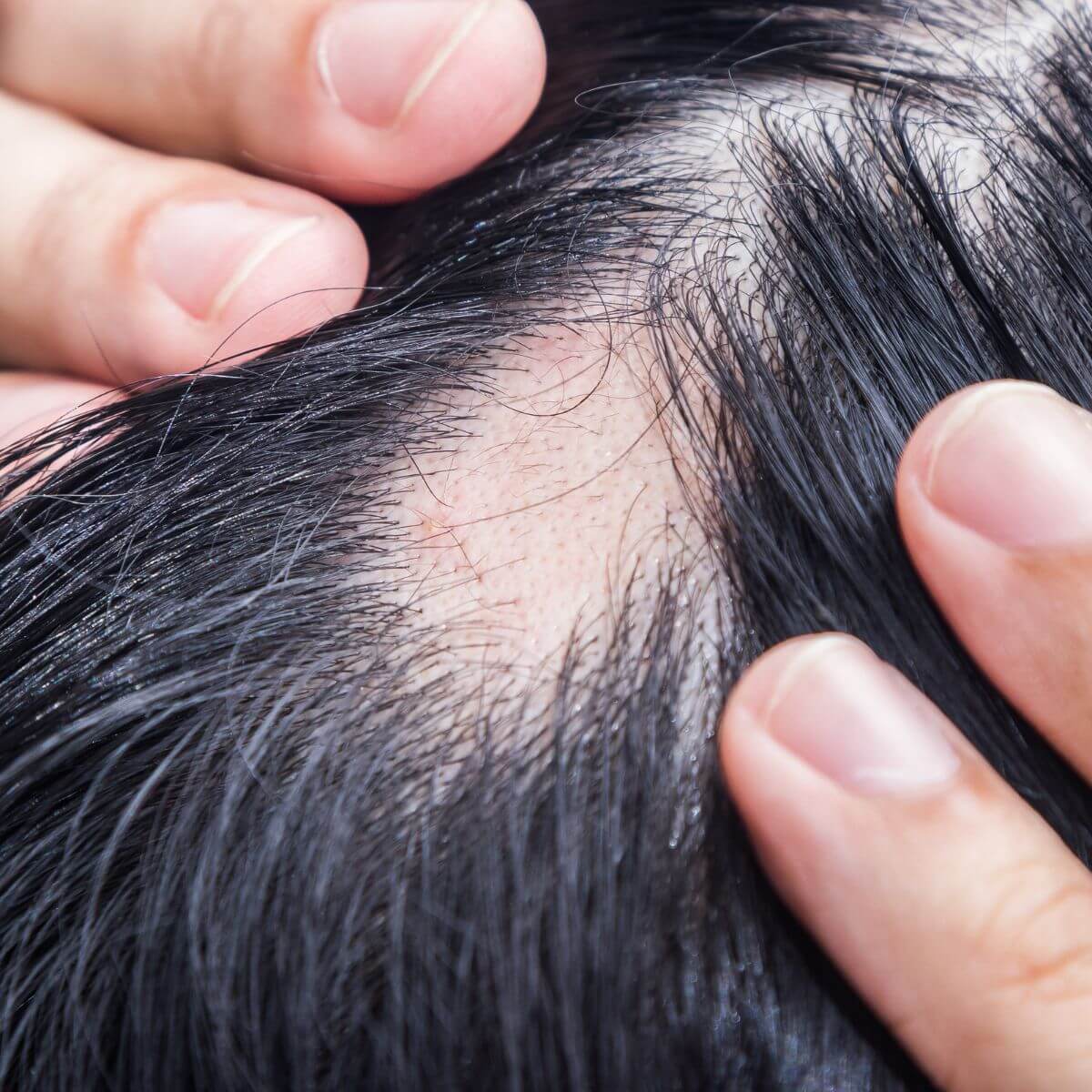 Close-up of a scalp showing a patch of hair loss.