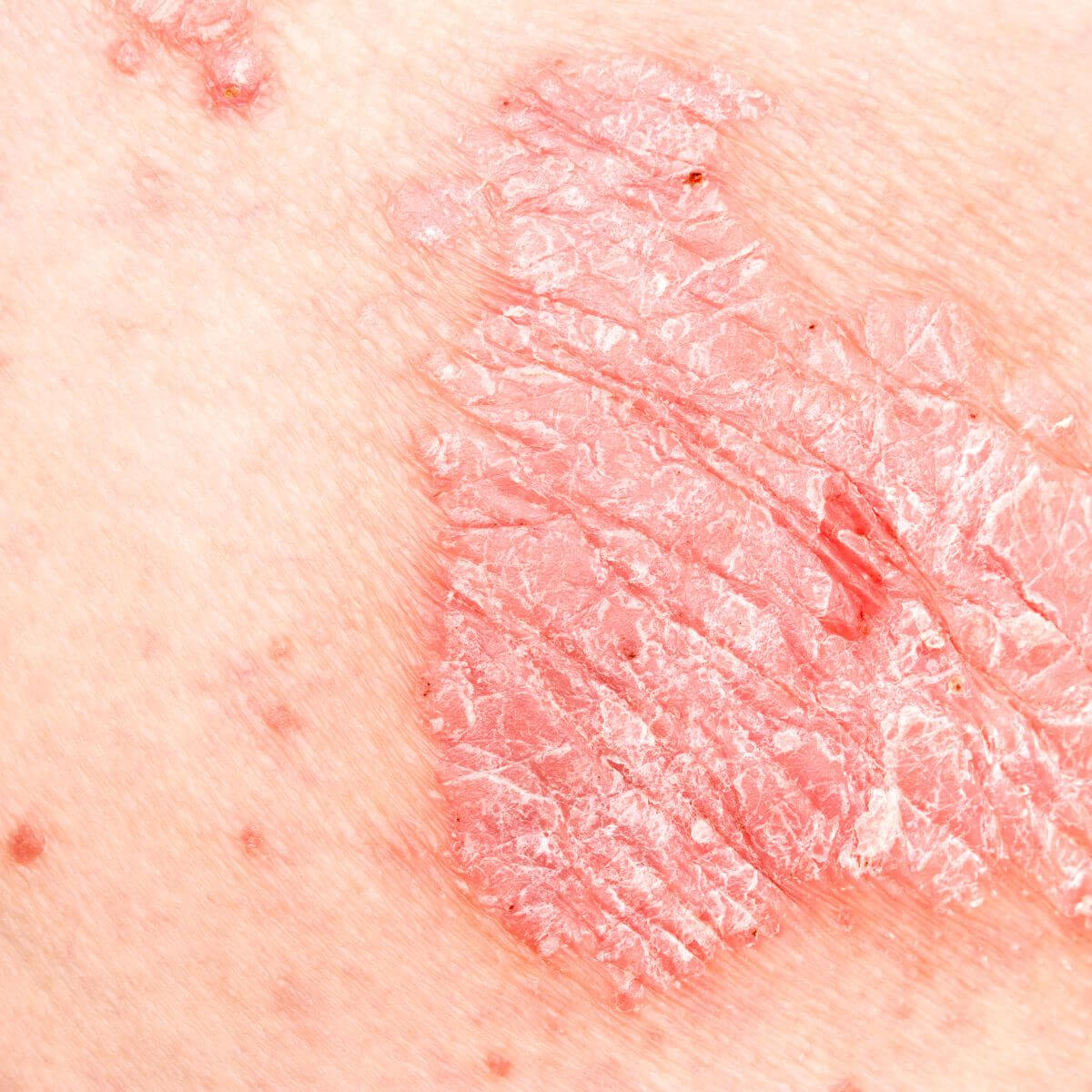 Close-up of a red, scaly patch of skin.